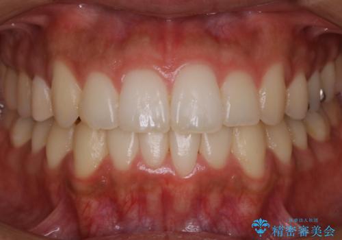 【非抜歯】インビザライン 出っ歯を治す!の症例 治療後