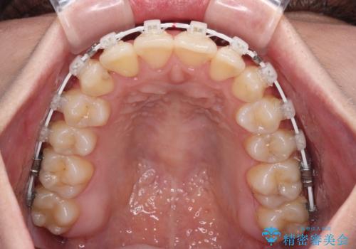 前歯のクロスバイトを短期間で解消　目立たないワイヤー矯正の治療中