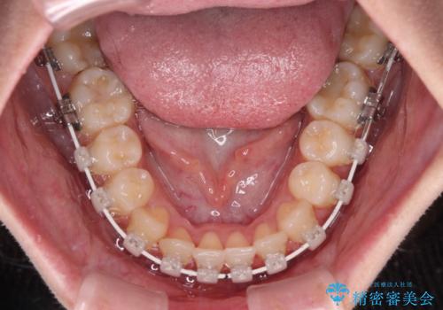 前歯のクロスバイトを短期間で解消 目立たないワイヤー矯正の治療中