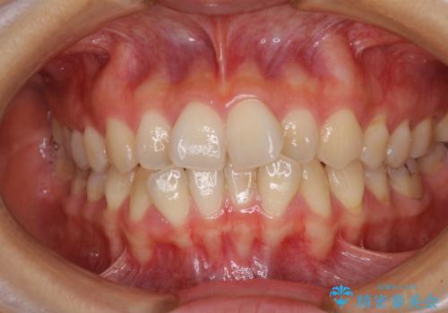 前歯のクロスバイト　ワイヤー装置を併用したインビザライン矯正の症例 治療前