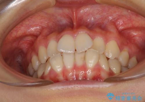 前歯のクロスバイト ワイヤー装置を併用したインビザライン矯正の治療前