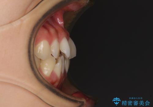 前歯のクロスバイト　ワイヤー装置を併用したインビザライン矯正の治療前