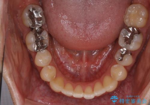 【非抜歯】インビザライン　出っ歯を治す!の治療後