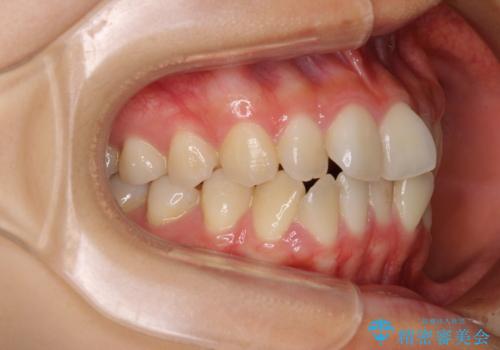 前歯のクロスバイト ワイヤー装置を併用したインビザライン矯正の治療前