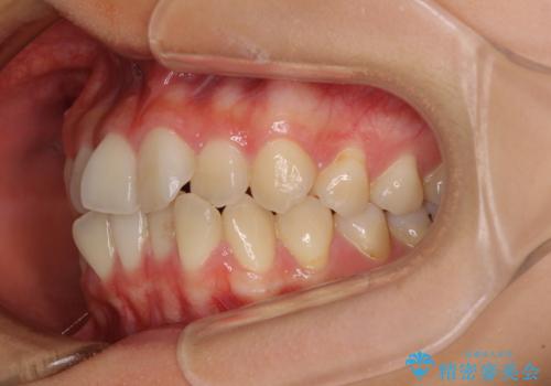 前歯のクロスバイト ワイヤー装置を併用したインビザライン矯正の治療前