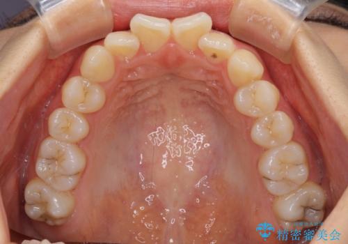 前歯のクロスバイト ワイヤー装置を併用したインビザライン矯正の治療前