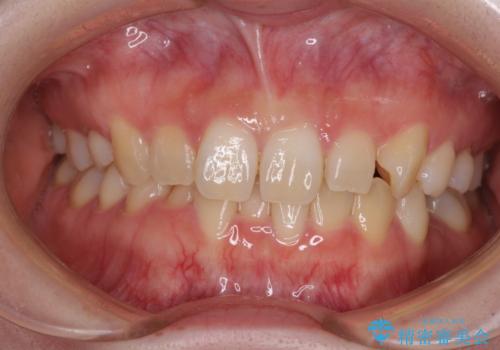 ディープバイトをインビザライン矯正で改善の症例 治療前