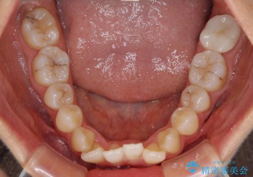前歯のクロスバイト ワイヤー装置を併用したインビザライン矯正の治療前