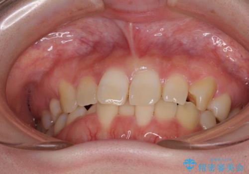 ディープバイトをインビザライン矯正で改善の治療前