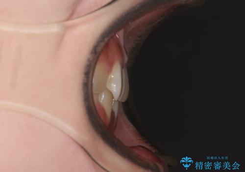 ディープバイトをインビザライン矯正で改善の治療前