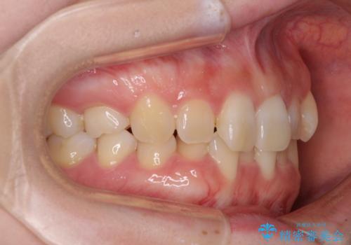 ディープバイトをインビザライン矯正で改善の治療前