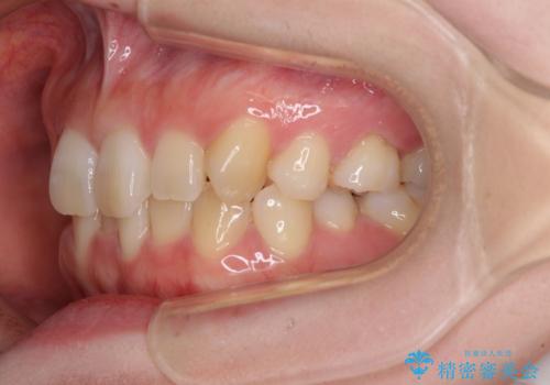 ディープバイトをインビザライン矯正で改善の治療前