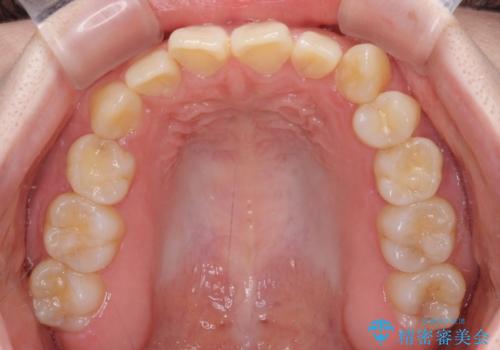 ディープバイトをインビザライン矯正で改善の治療前