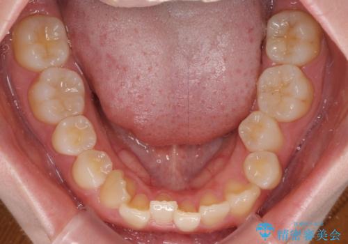 ディープバイトをインビザライン矯正で改善の治療前