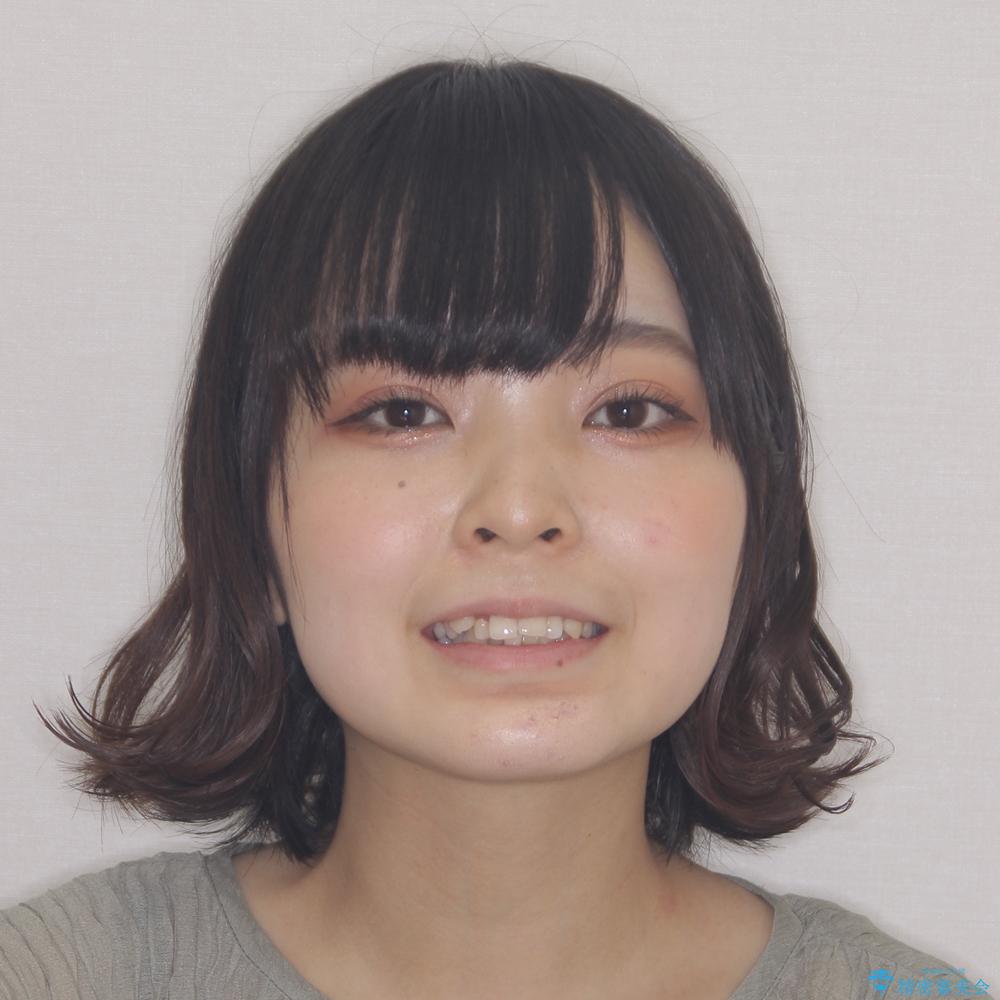 【モニター】八重歯とデコボコをスッキリきれいに ワイヤー装置での抜歯矯正の治療前(顔貌)