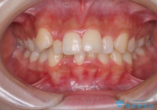 【モニター】八重歯とデコボコをスッキリきれいに　ワイヤー装置での抜歯矯正の治療前
