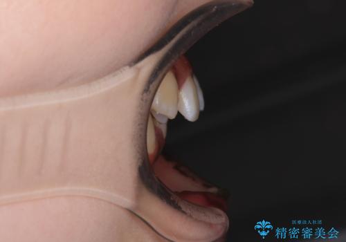 【モニター】八重歯とデコボコをスッキリきれいに ワイヤー装置での抜歯矯正の治療前