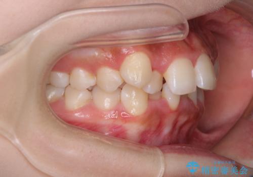 【モニター】八重歯とデコボコをスッキリきれいに ワイヤー装置での抜歯矯正の治療前