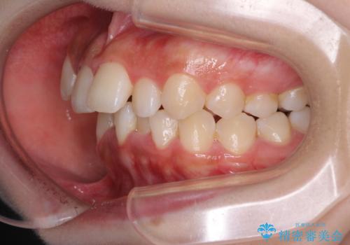 【モニター】八重歯とデコボコをスッキリきれいに ワイヤー装置での抜歯矯正の治療前