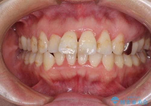 出っ歯による口の閉じにくさを治したい　ワイヤー装置を用いた抜歯矯正の治療前