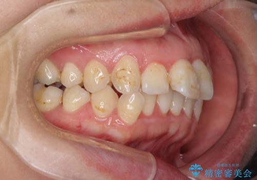 出っ歯による口の閉じにくさを治したい　ワイヤー装置を用いた抜歯矯正の治療前