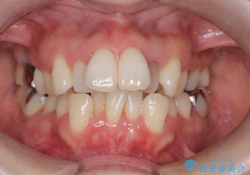 重度のガタガタと出っ歯をワイヤーによる抜歯矯正で整った歯並びへの治療前