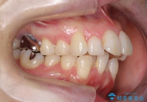 重度のガタガタと出っ歯をワイヤーによる抜歯矯正で整った歯並びへの治療前