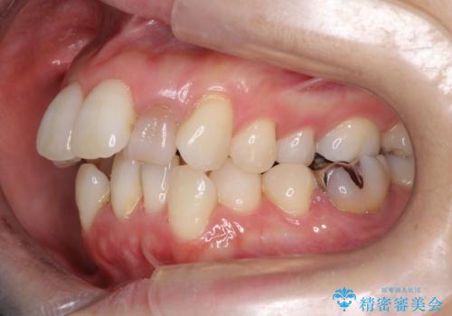 重度のガタガタと出っ歯をワイヤーによる抜歯矯正で整った歯並びへの治療前