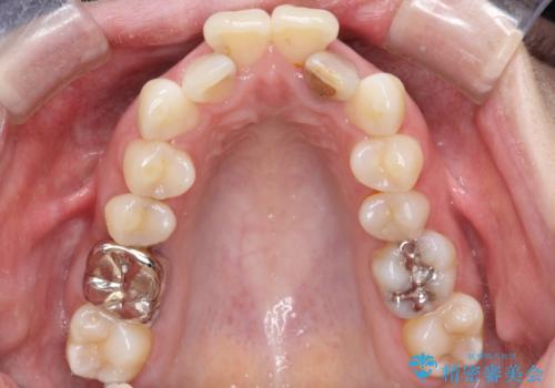 重度のガタガタと出っ歯をワイヤーによる抜歯矯正で整った歯並びへの治療前