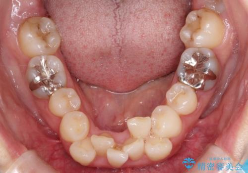 重度のガタガタと出っ歯をワイヤーによる抜歯矯正で整った歯並びへの治療前