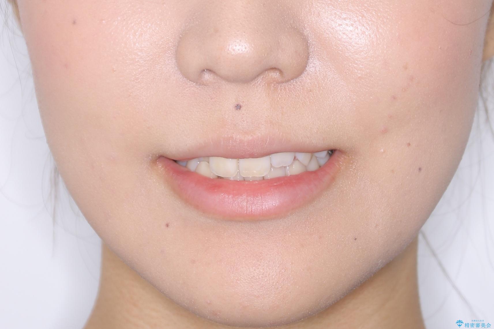 【非抜歯】インビザライン 隠れた前歯を並べる矯正治療の治療前(顔貌)