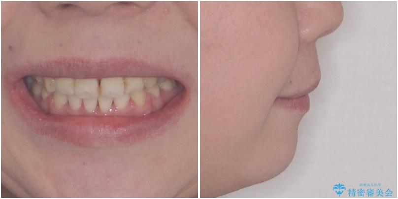 出っ歯による口の閉じにくさを治したい　ワイヤー装置を用いた抜歯矯正の治療後（顔貌）