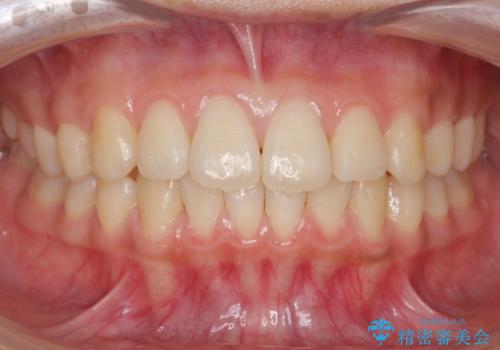 前歯のがたつき　部分矯正でコストダウンしながら、かみ合わせも治療の治療後
