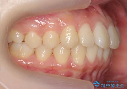 前歯のがたつき 部分矯正でコストダウンしながら、かみ合わせも治療の治療後