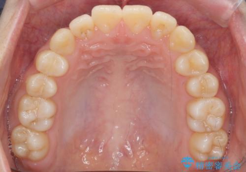 前歯のがたつき 部分矯正でコストダウンしながら、かみ合わせも治療の治療後