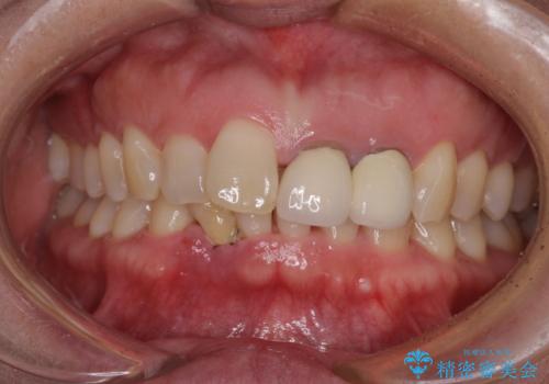 前歯のインプラント治療　折角なので矯正治療できれいな歯並びにの治療前