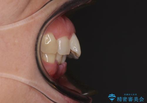 前歯のインプラント治療　折角なので矯正治療できれいな歯並びにの治療前