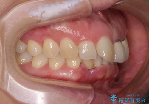 前歯のインプラント治療　折角なので矯正治療できれいな歯並びにの治療前