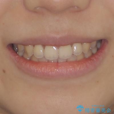 受け口と開咬を急速拡大装置とワイヤー装置で改善の治療後(顔貌)