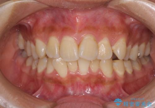 デコボコで磨きにくい前歯をスッキリと　インビザライン矯正の治療前
