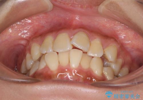 デコボコで磨きにくい前歯をスッキリと インビザライン矯正の治療前