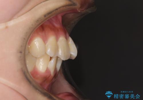 デコボコで磨きにくい前歯をスッキリと インビザライン矯正の治療前