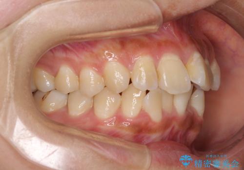 デコボコで磨きにくい前歯をスッキリと インビザライン矯正の治療前