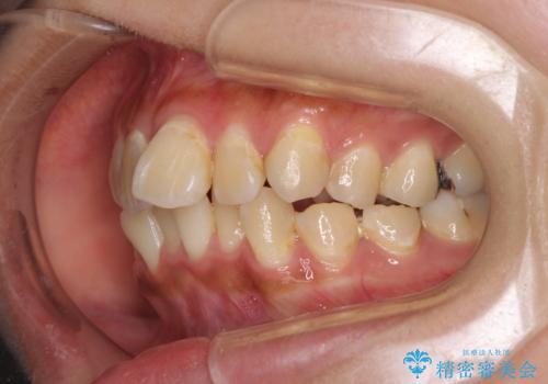 デコボコで磨きにくい前歯をスッキリと　インビザライン矯正の治療前