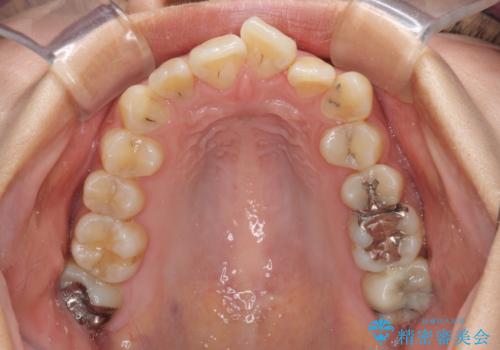 デコボコで磨きにくい前歯をスッキリと インビザライン矯正の治療前