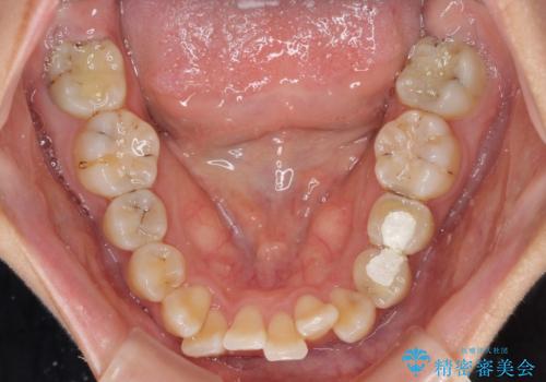 デコボコで磨きにくい前歯をスッキリと インビザライン矯正の治療前