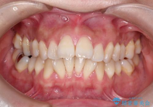 出っ歯で口が閉じずらい　ワイヤー抜歯矯正の治療前