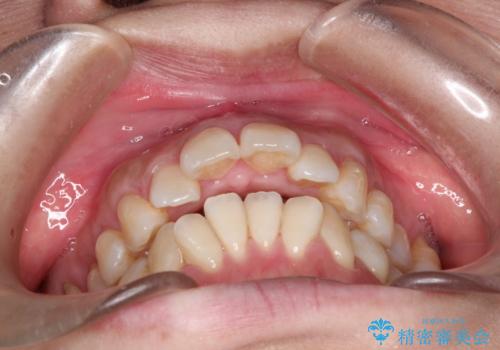 出っ歯で口が閉じずらい ワイヤー抜歯矯正の治療前