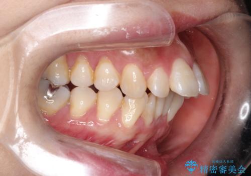 出っ歯で口が閉じずらい　ワイヤー抜歯矯正の症例 治療前
