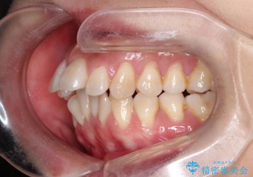 出っ歯で口が閉じずらい　ワイヤー抜歯矯正の治療前
